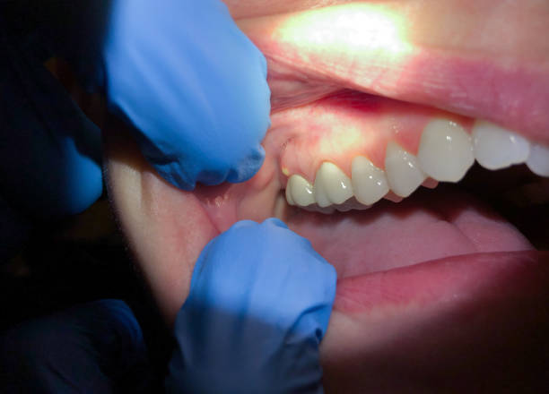 Best Emergency Dental Care for Abscessed Tooth in North Hills, NY